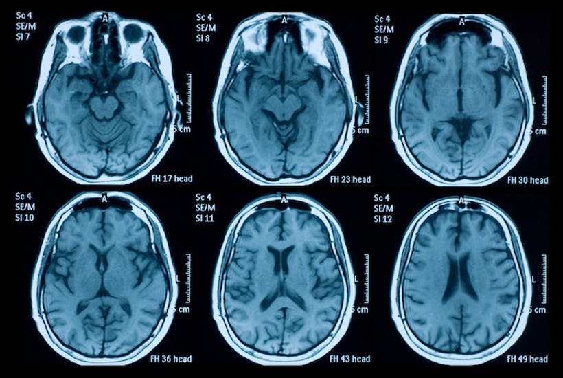 magnetic resonance images of brains in mri scans - stock photo