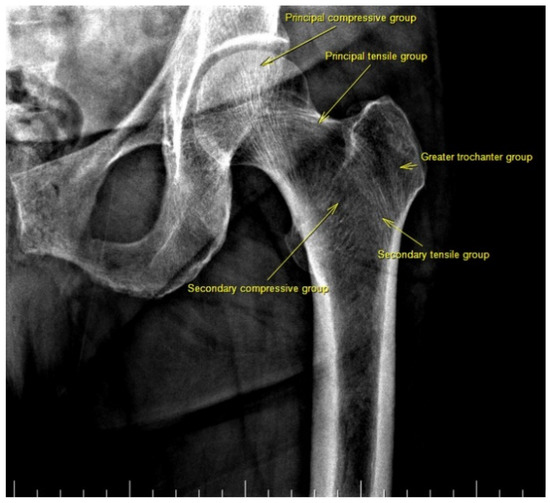 hip in bone density scan - with labels of bone groups